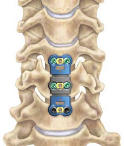 CERVICAL DISCECTOMY AND FUSION