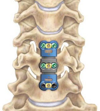 Cervical Discectomy and Fusion