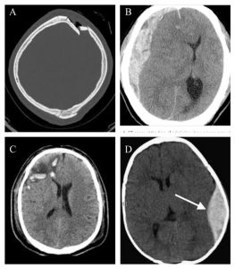 CT scan showing different types of brain trauma. A depressed fracture Bsubdural hematoma C brain contusion Depidural hematoma