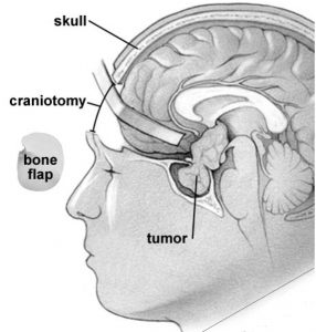 Craniotomy for pituitary surgery