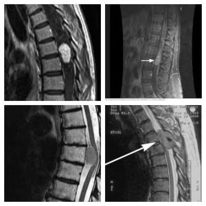 Different spinal tumors observed on MRI