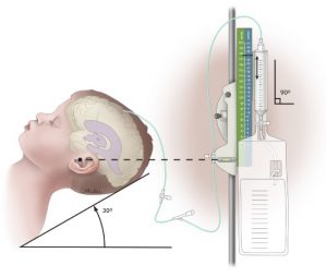 Intracranial pressure monitoring