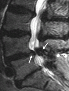 MRI ls stenosis