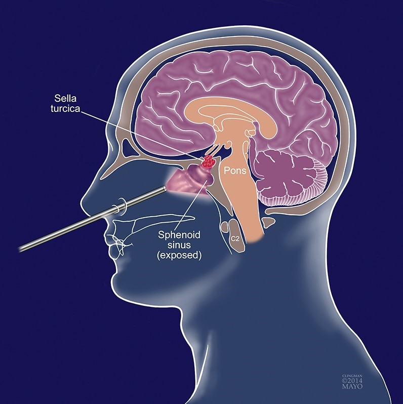 What Is The Recovery Time After Pituitary Tumor Surgery