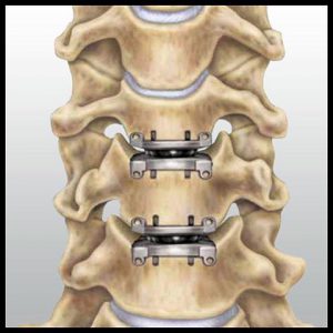 cervical disc replacement procedure