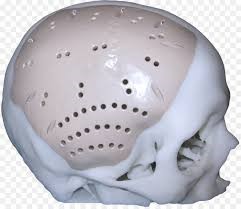 Cranioplastia