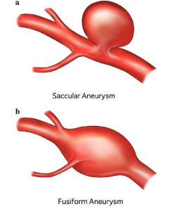 Types of Aneurysms